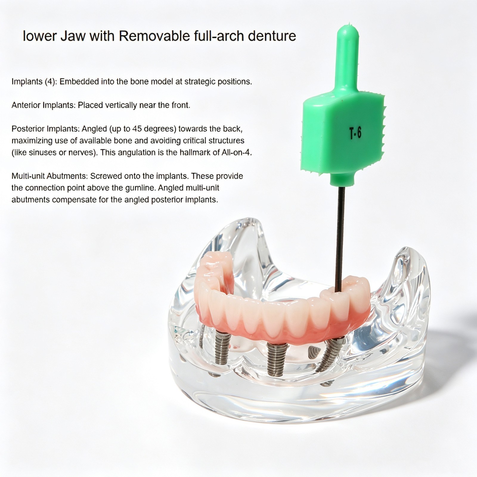 Clear Base Detachable All-on-4 /All-on-6 Overdenture Dental Implant Study Model