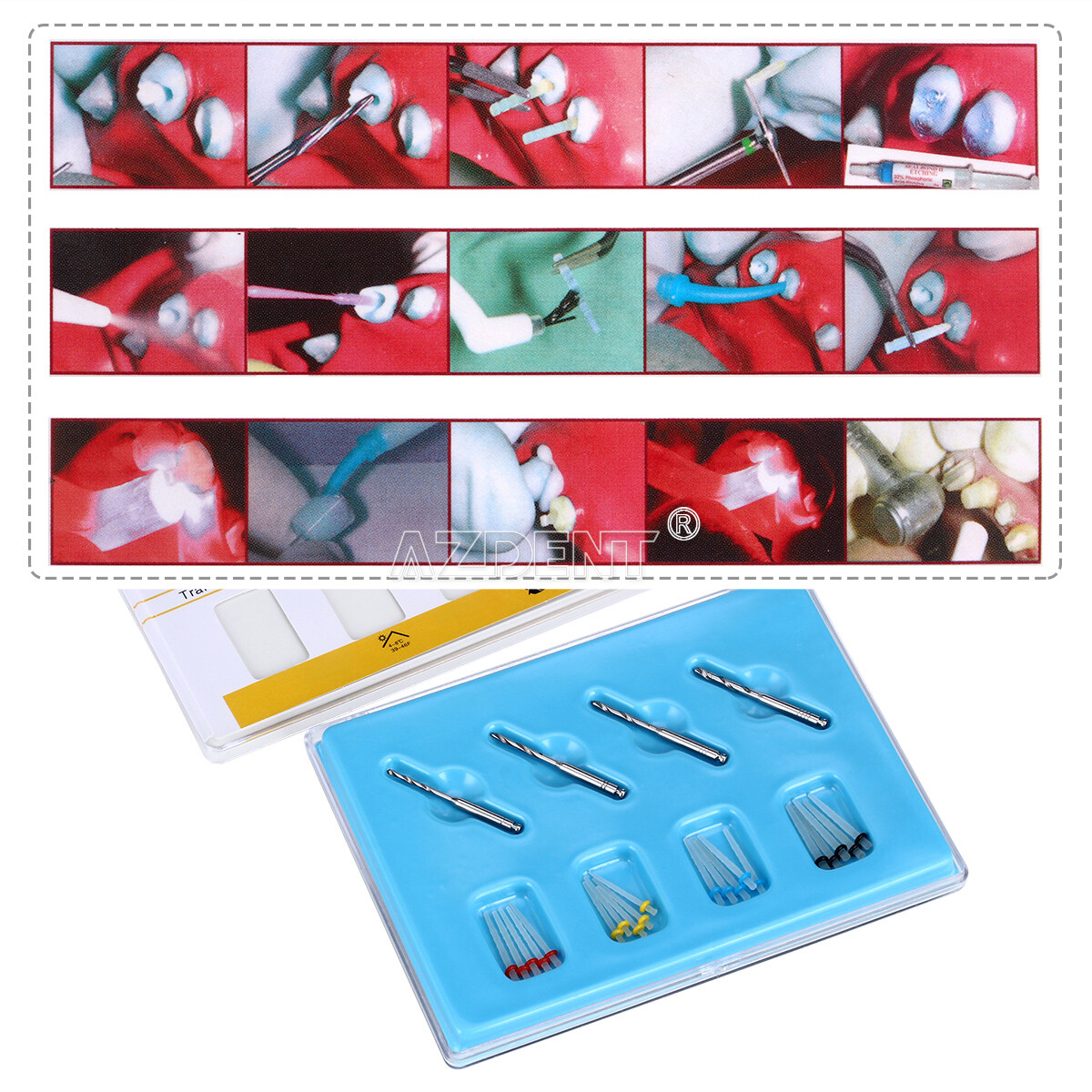 5 Kit Dental AAA Fiber Post Resin High-intensity Screw Thread Glass+20pcs Drills