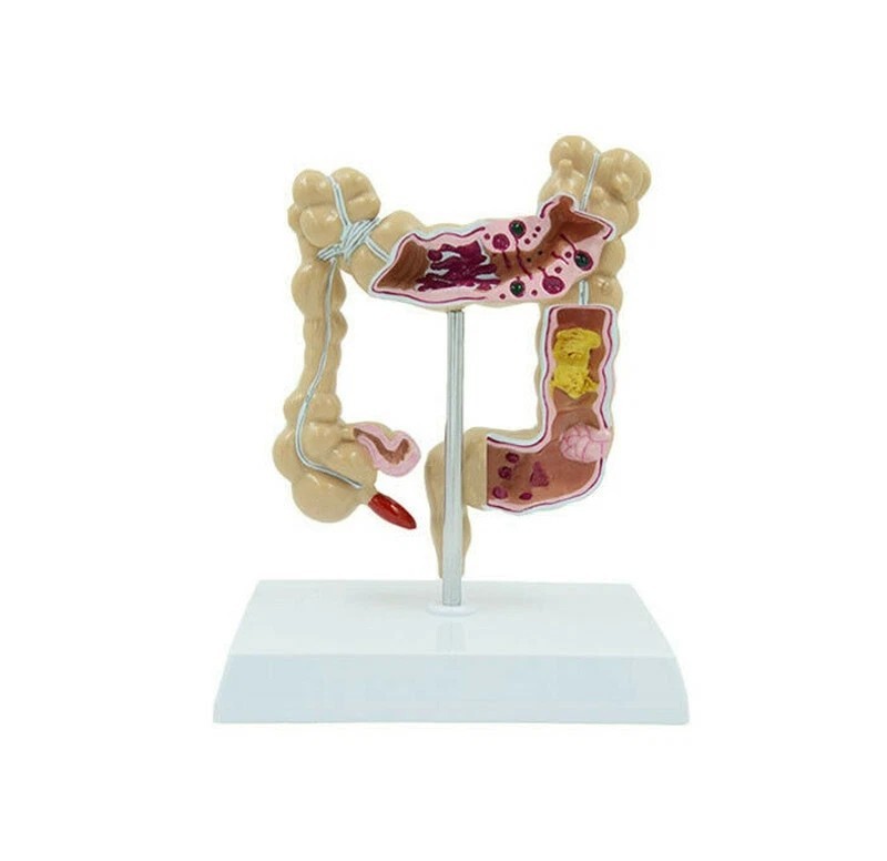 Anatomical Human Colon Intestine Pathological Diseases Model Medical Anatomy