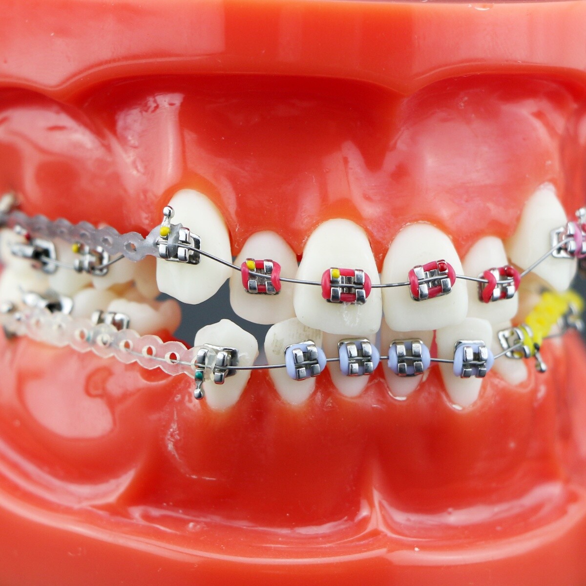 Dental Typodont Teeth Model Orthodontic Treatment Metal Ceramic BracketsRetainer