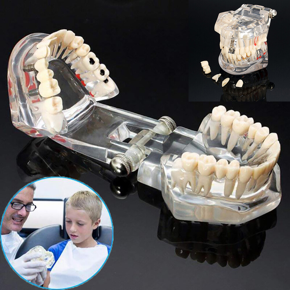 Dental Fake Teeth Study Model Implant Disease Education Denture Teach Analy