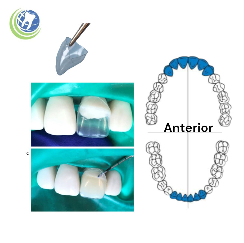 DENTAL TRANSPARENT STRIP OFF CROWNS ANTERIOR 60PC ADULT KIT DENTAL EMPORIUM