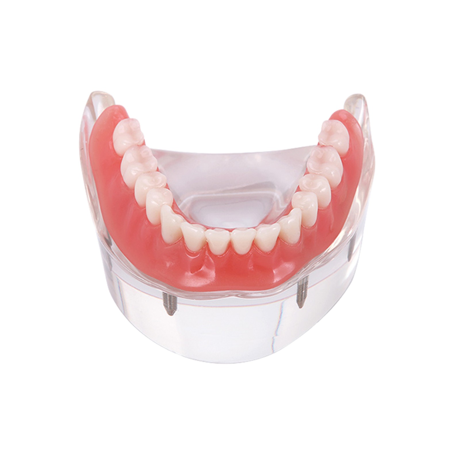 US Dental Implant Teeth Model Overdenture Restoration With4 Implants Upper Lower
