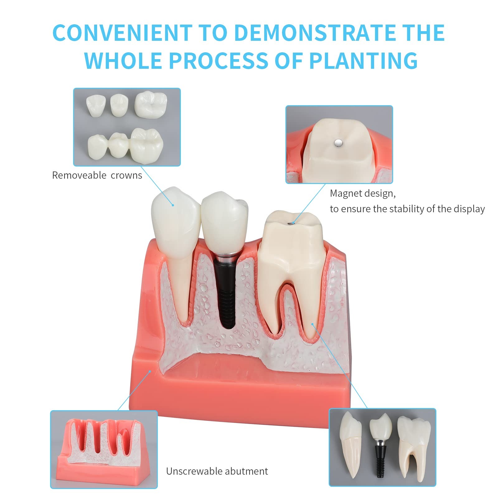 ANNWAN Dental Implant Model 4 Times Removable Analysis 4
