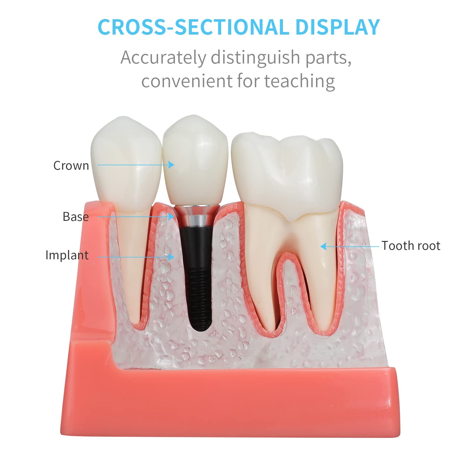 ANNWAN Dental Implant Model 4 Times Removable Analysis 4