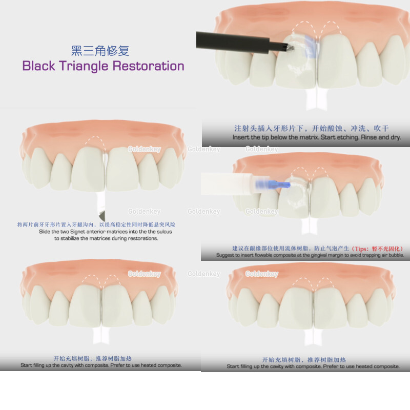 Clear Matrix Band Transparent Bow Matrices Dental Anterior Front Teeth Posterior