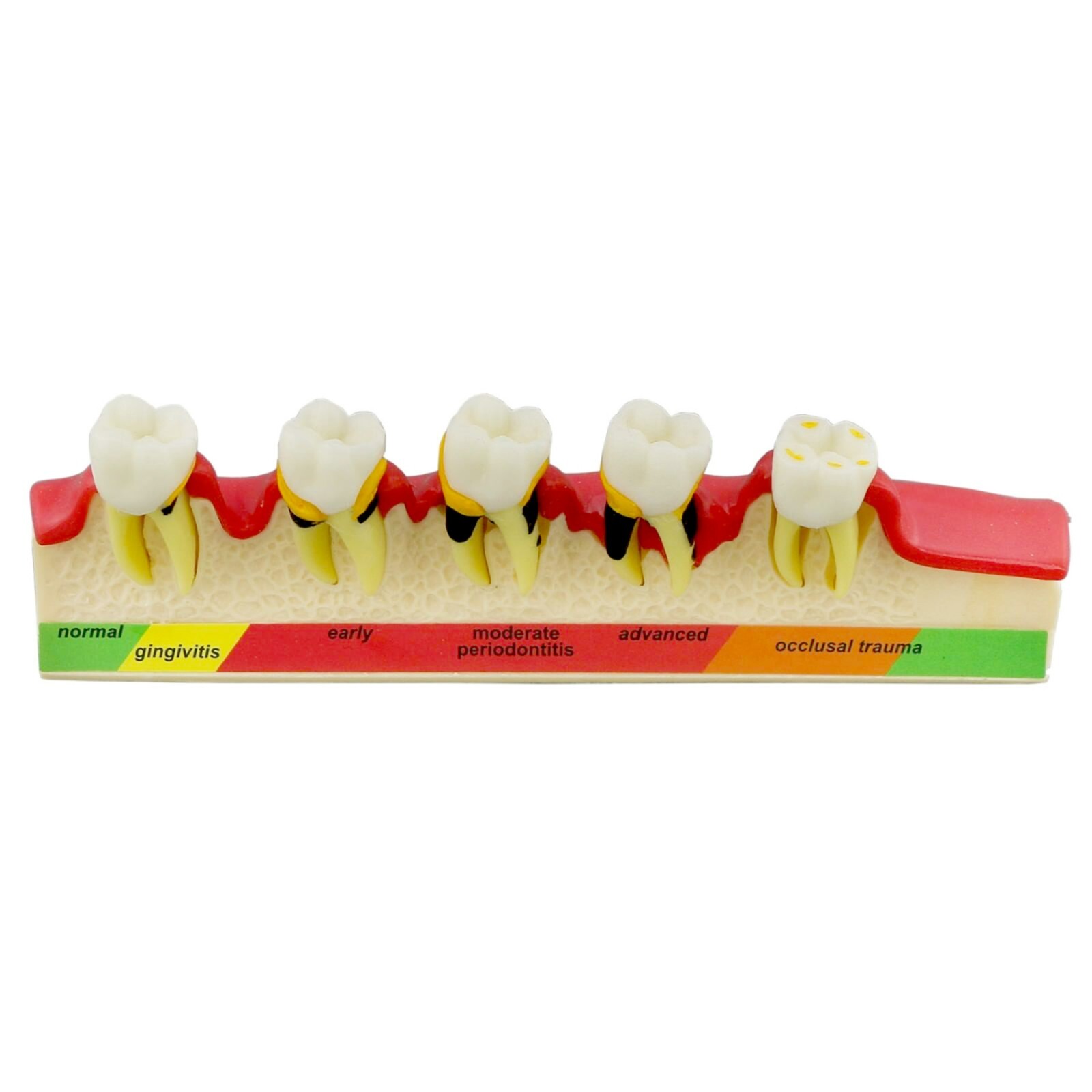 Dental Periodontics Disease 5-Stage Teeth Model Perio Disease Assort Demo Model