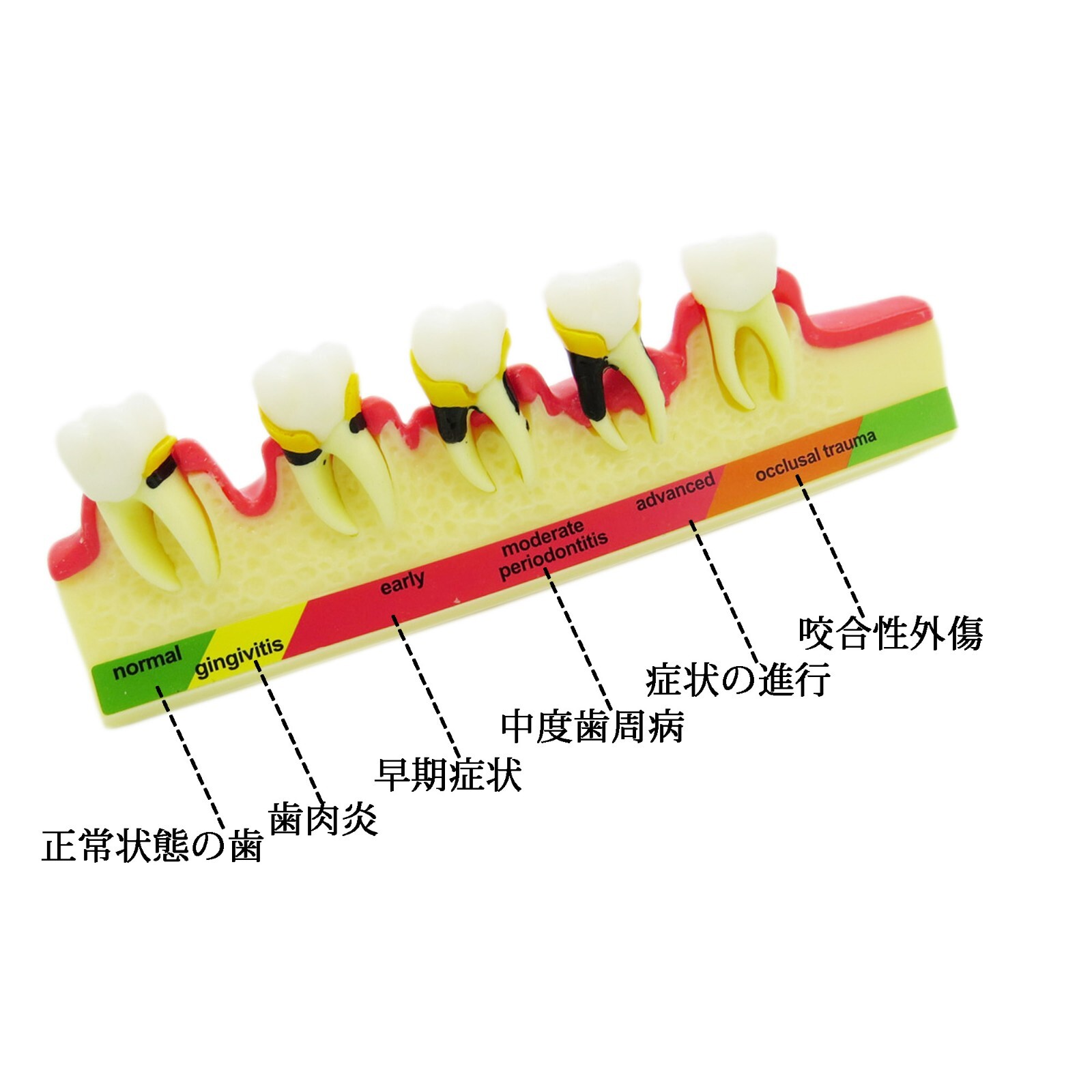 Dental Periodontics Disease 5-Stage Teeth Model Perio Disease Assort Demo Model