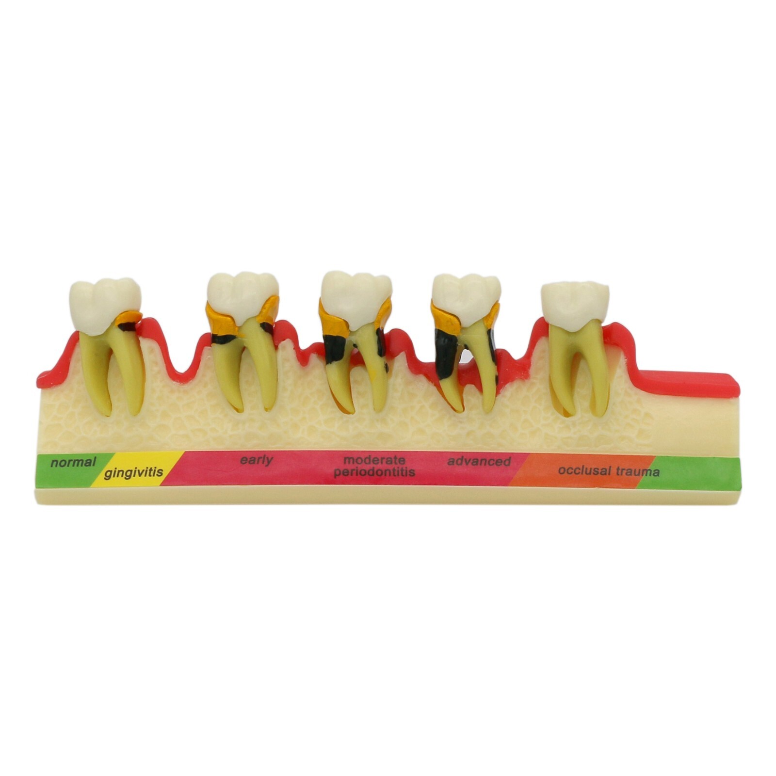Dental Periodontics Disease 5-Stage Teeth Model Perio Disease Assort Demo Model