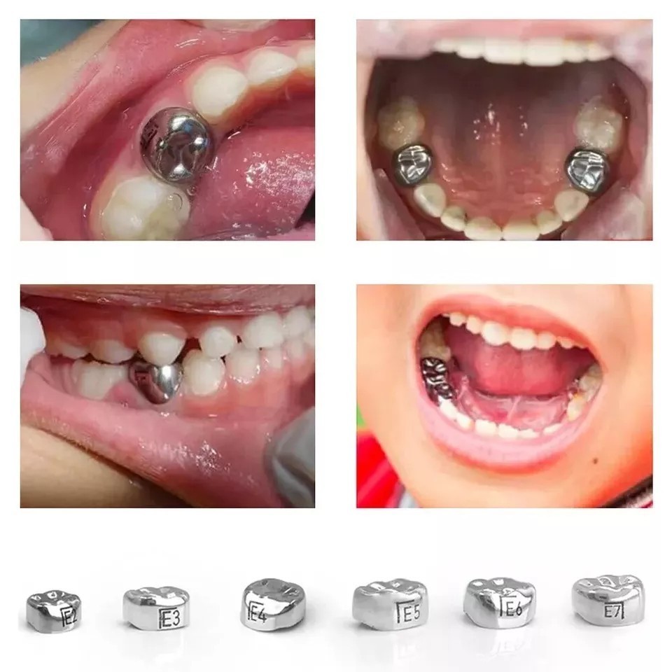 5 Pcs/Box Dental Stainless Steel Kids Primary Molar Crown Pediatric Metal Crowns