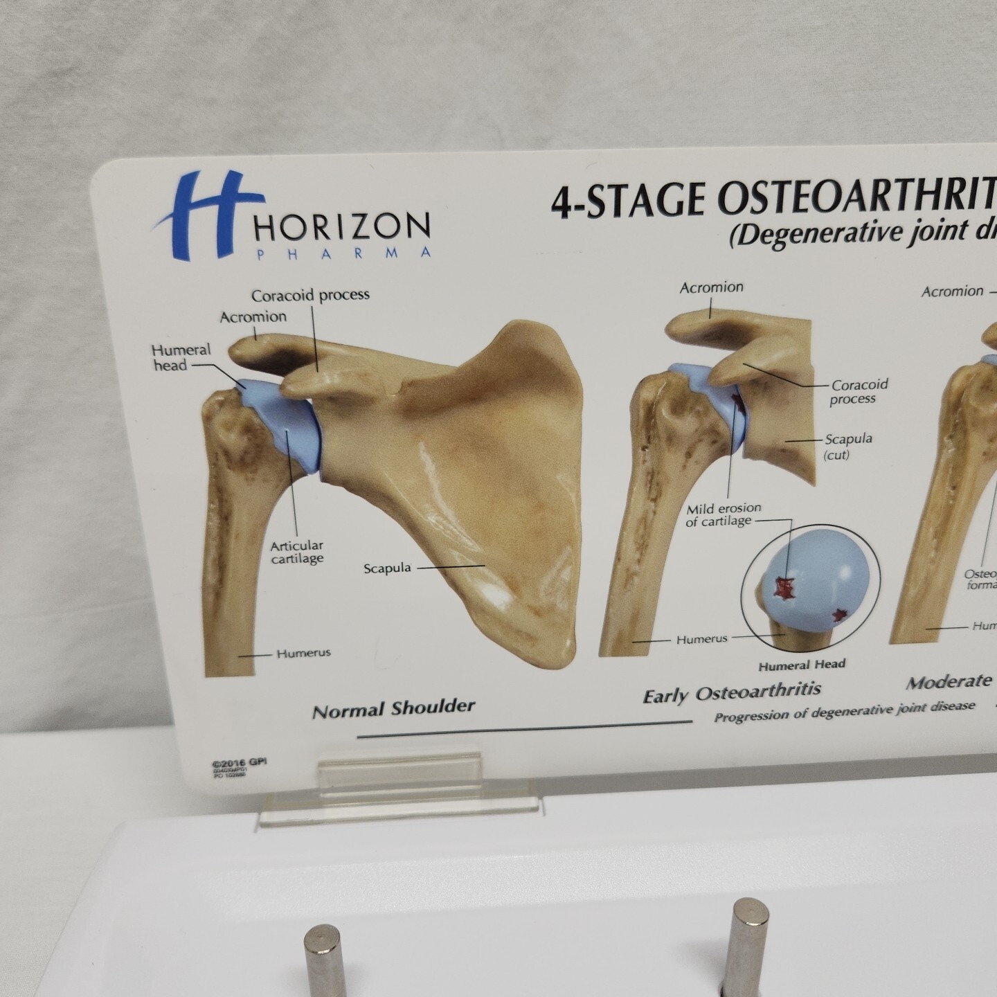 Degenerative Joint Disease 4 Stage Osteoarthritis Osteoarthritic Shoulder Model