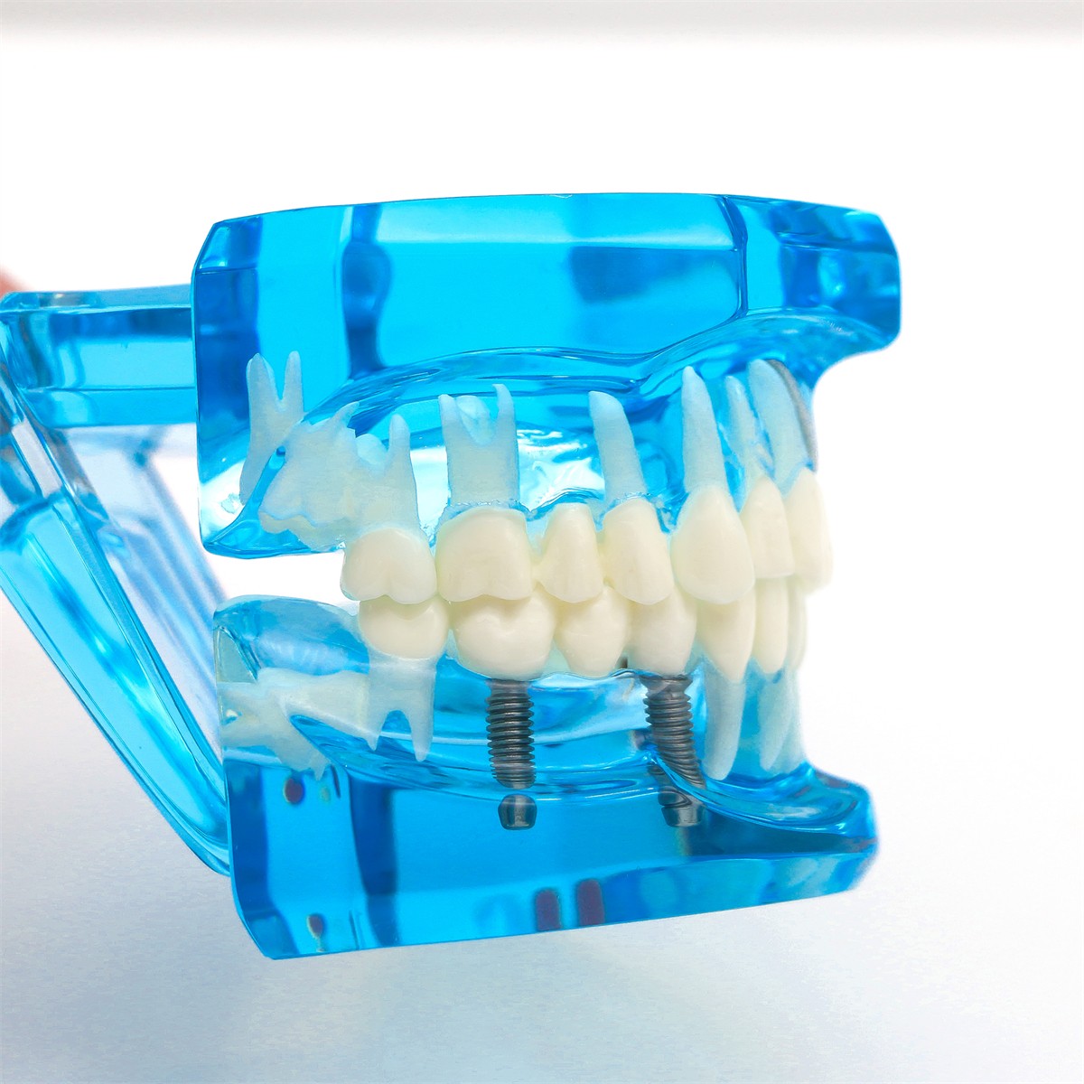 US Dental Typodont Teeth Model Implant Restoration Orthodontics Demo Teaching