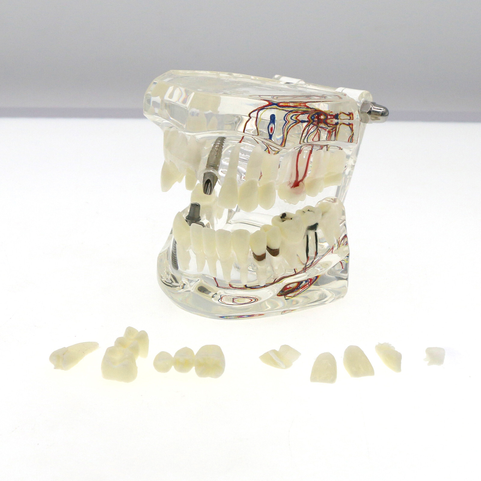 Dental Oral Typodont Model Implant Pathological Removable Teach Visible Anatomy