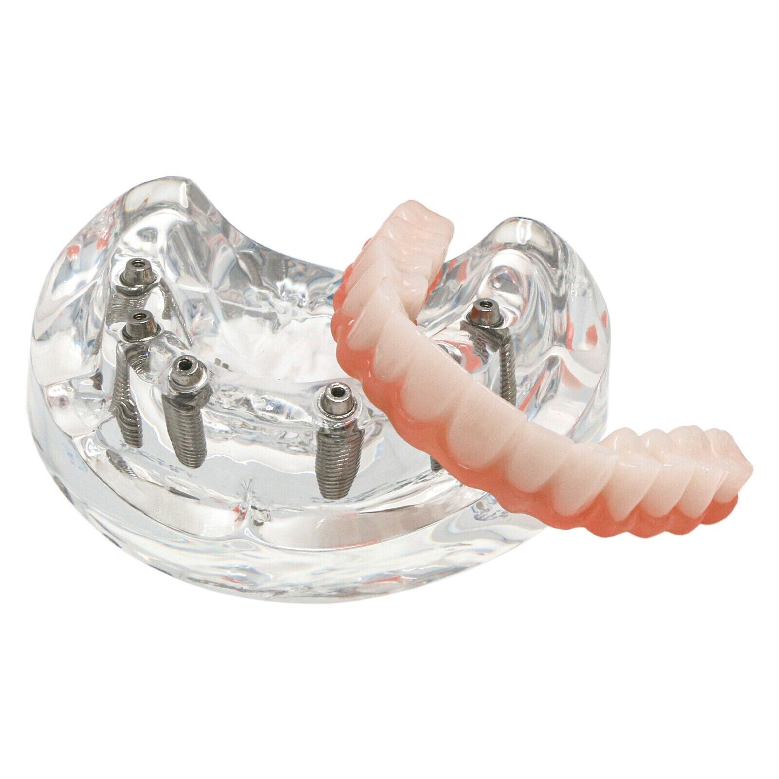US Dental Implant Restoration Model Upper Jaw 6 Screws Post Core Bridge M6001-2
