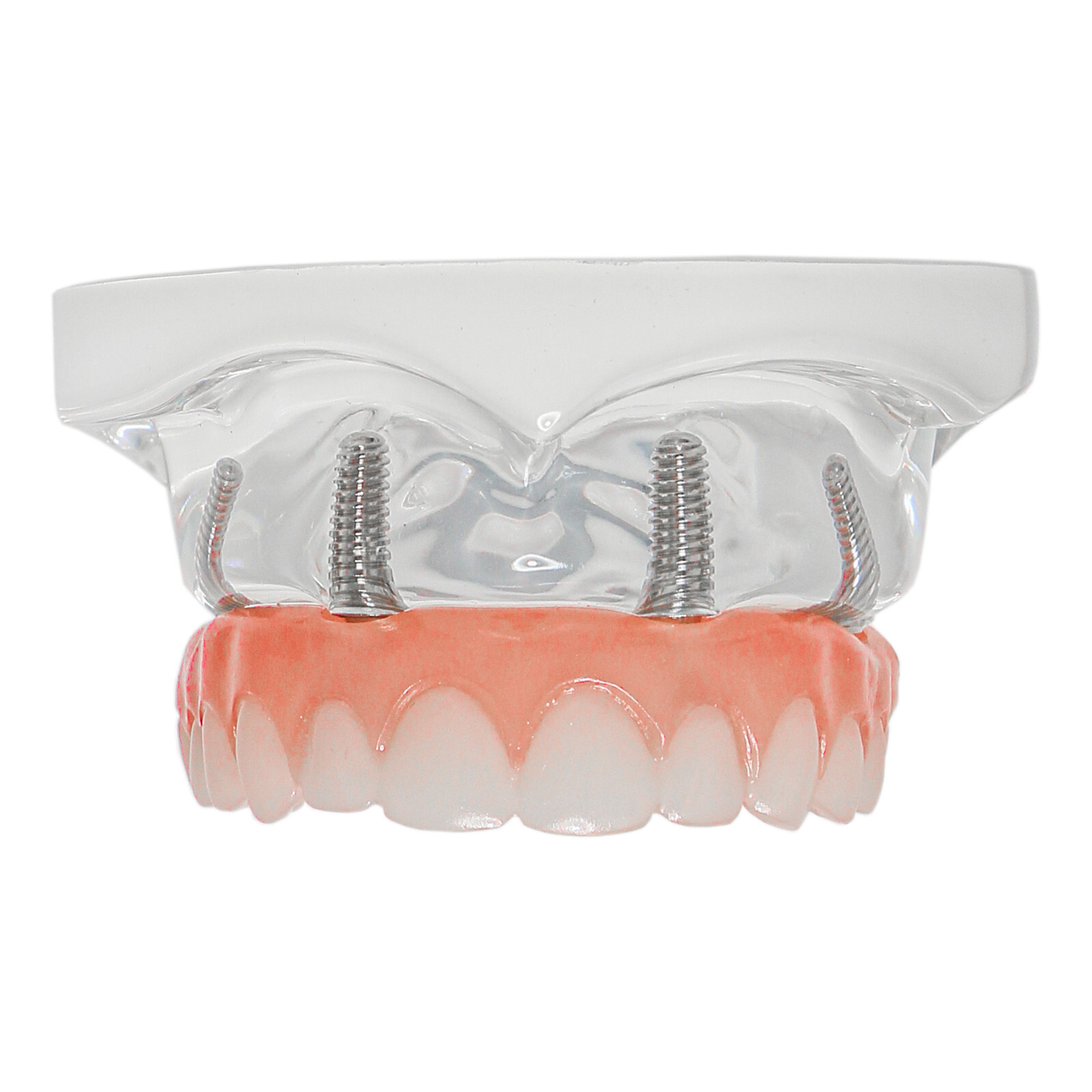 Dental 4 Implants Upper&Lower Demo Implant Teeth Model Restoration Overdenture