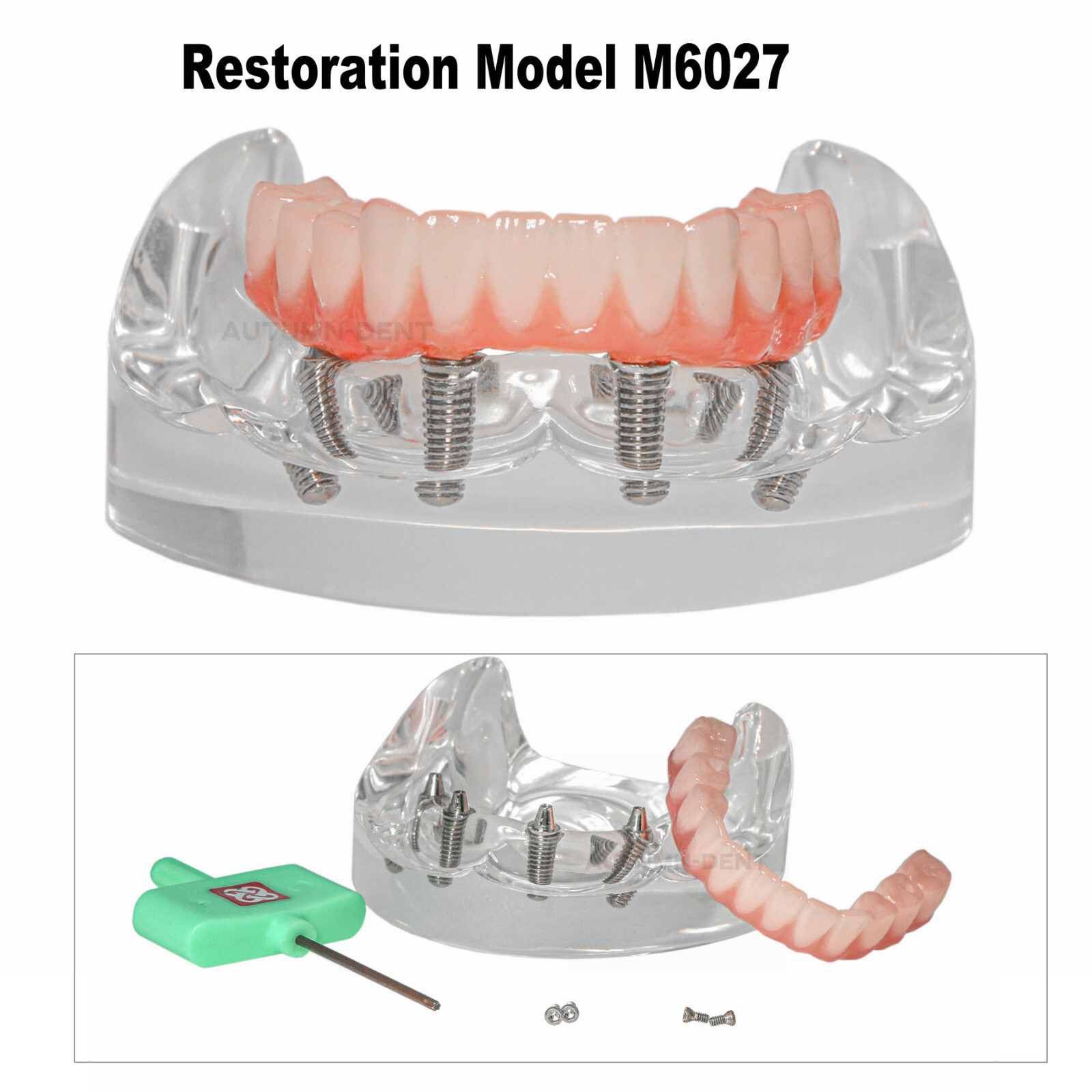 Dental 4 Implants Upper&Lower Demo Implant Teeth Model Restoration Overdenture