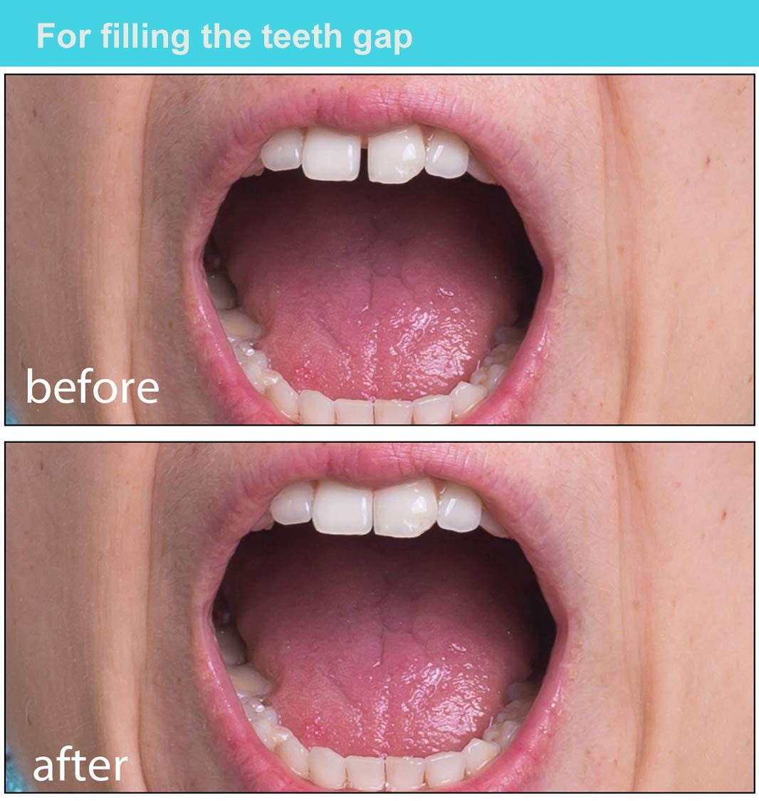 Brige Tooth Repair kit for Filling The Missing Broken 1 Count (Pack of 1)