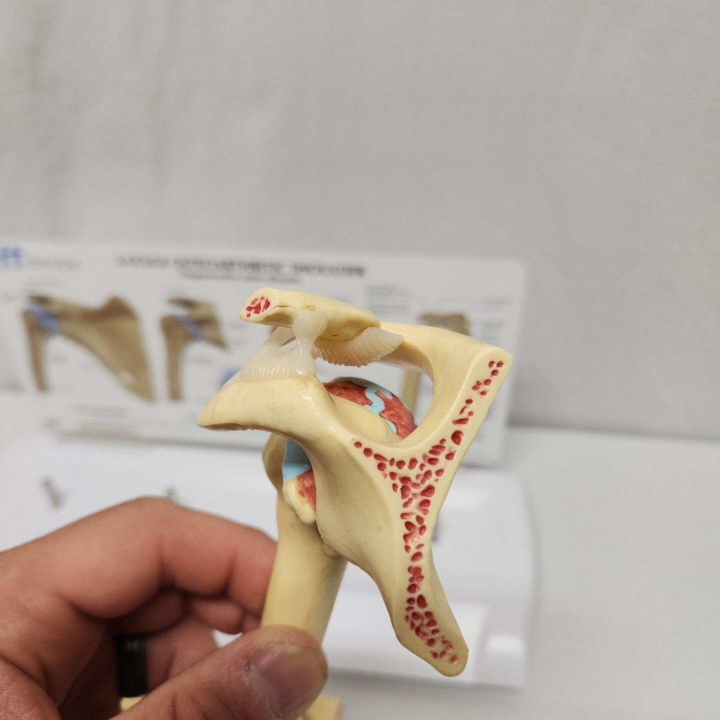 Degenerative Joint Disease 4 Stage Osteoarthritis Osteoarthritic Shoulder Model
