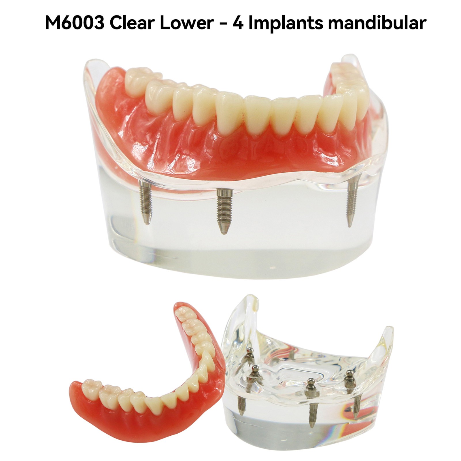 Dental Teeth Model 2 4 Implant Overdenture Typodont Restoration Demo Upper Lower