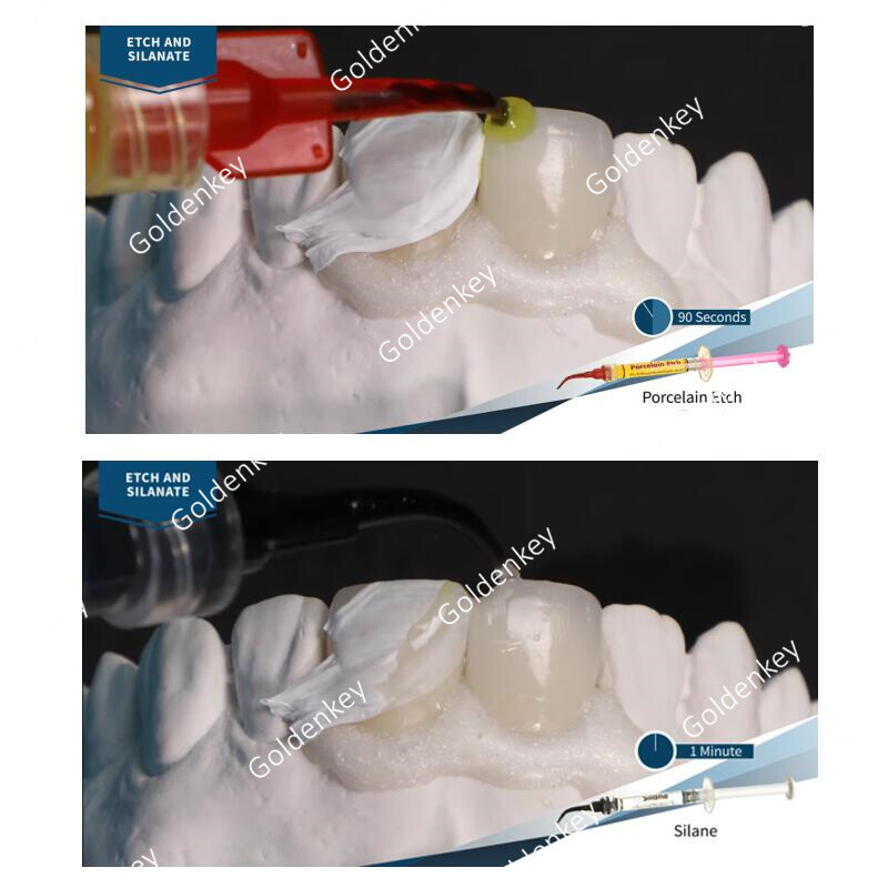 Dental Porcelain Etch Silane Ultradent 9% Hydrofluoric Repari Kit