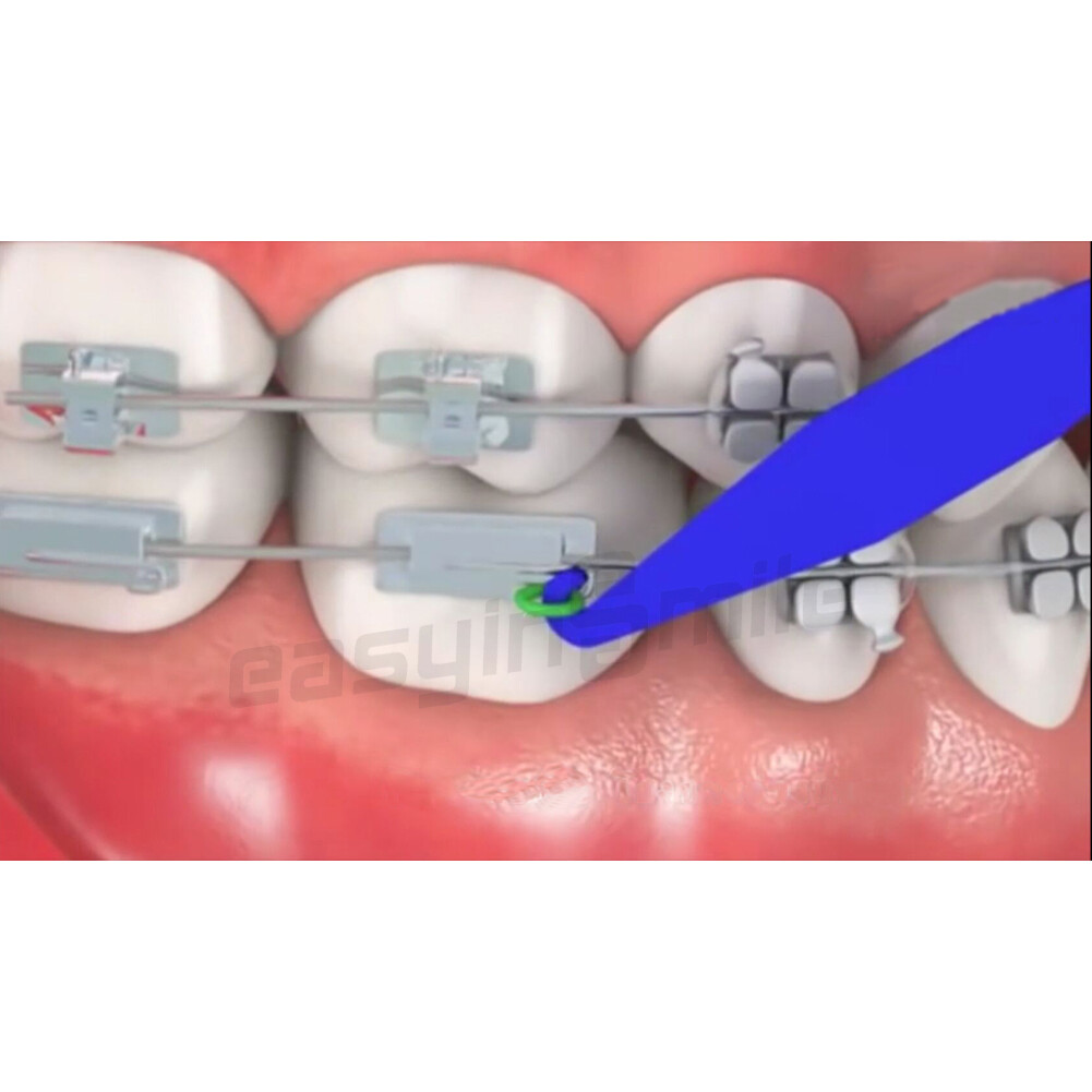 100Pcs Dental Orthodontic Placers 6cm Elastic Rubber Band Mix Color For Braces
