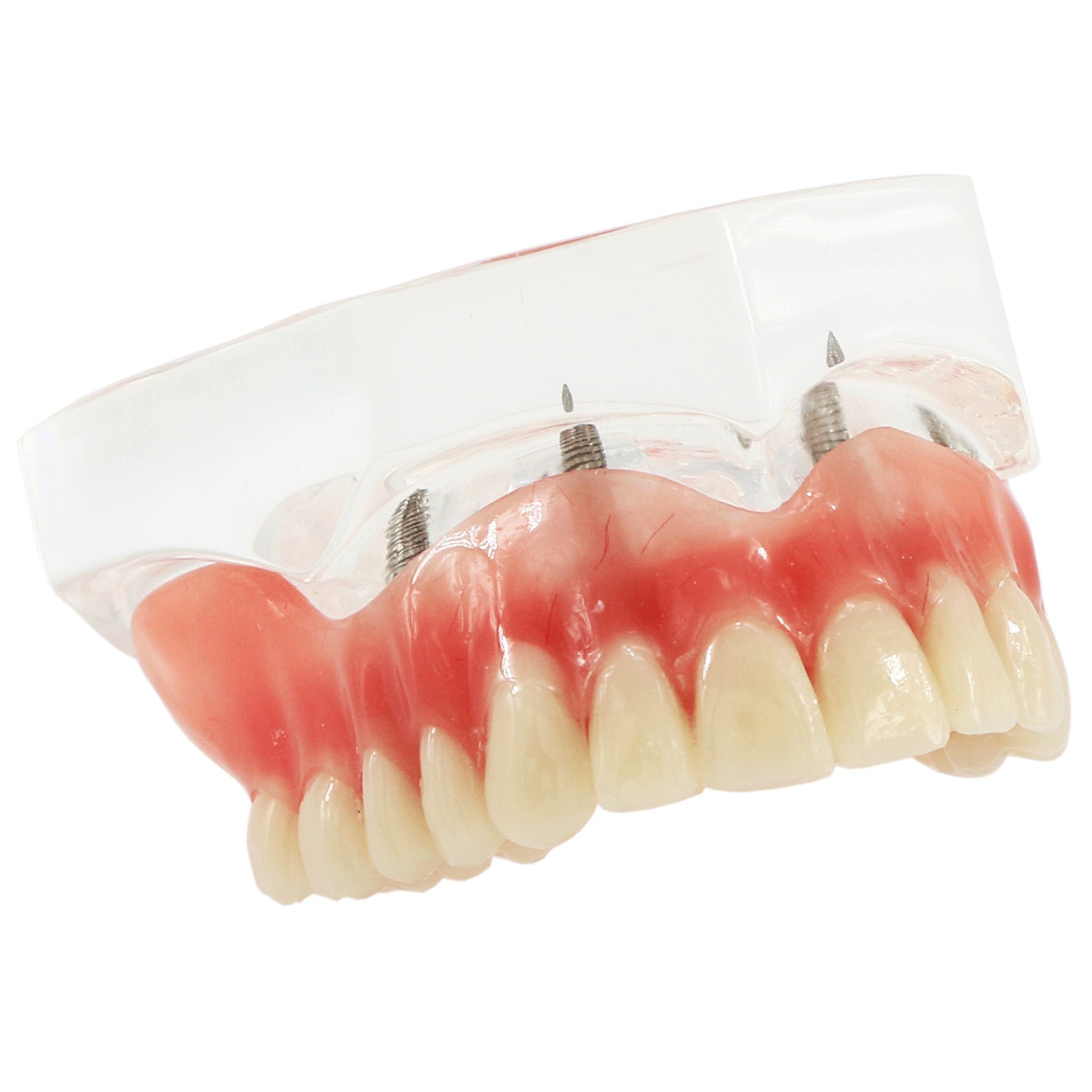 Dental Teeth Model 2 4 Implant Overdenture Typodont Restoration Demo Upper Lower