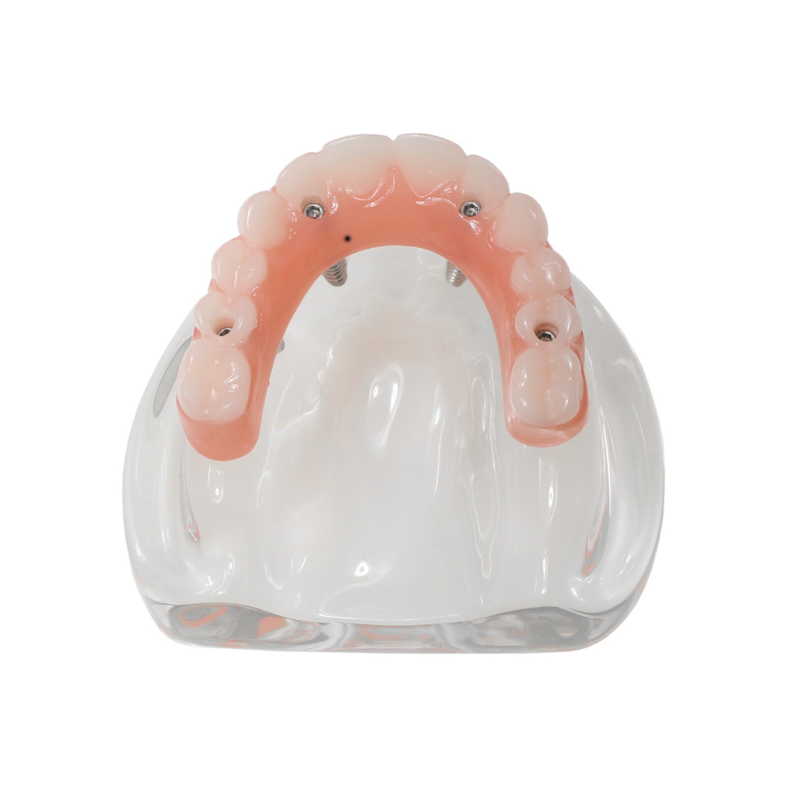 Dental Implant Overdenture Model Upper Lower Jaw Teeth Model with 2/4/6 Screws
