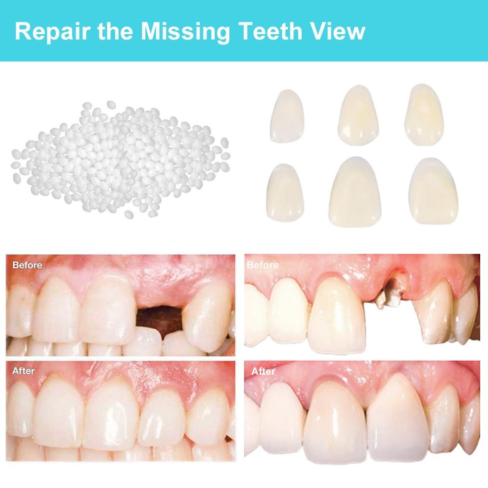 Brige Tooth Repair kit for Filling The Missing Broken 1 Count (Pack of 1)