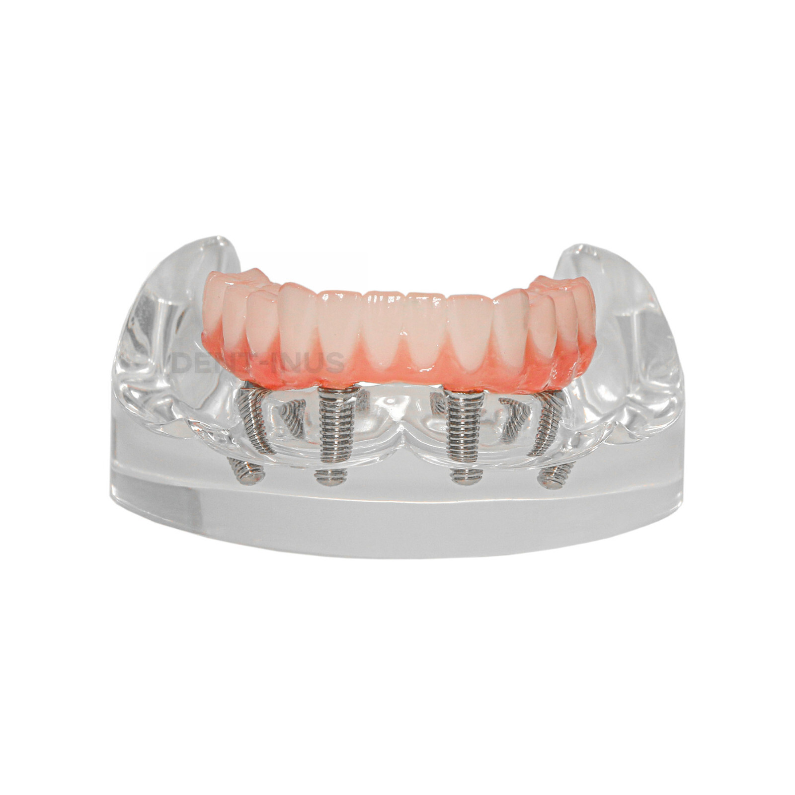 US Dental Overdenture All-on-4 Model Upper/Lower Jaw-Clear Implant With 4 Screws