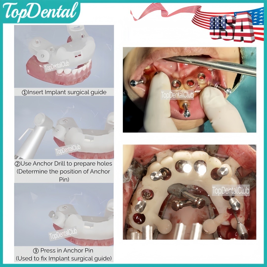 USA Dental 3DDX ⌀1.5 Long Guided Fixation Anchor Pin Denture Implant Plate DSG