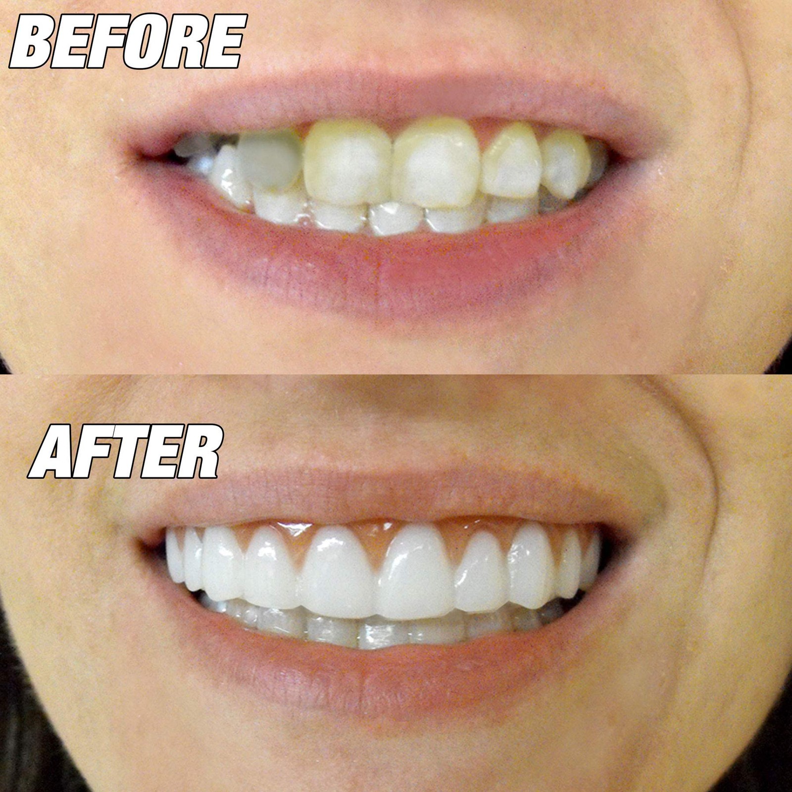 Instant Smile Flexible Lower Veneer Removable Cosmetic 1 Count (Pack of 1)