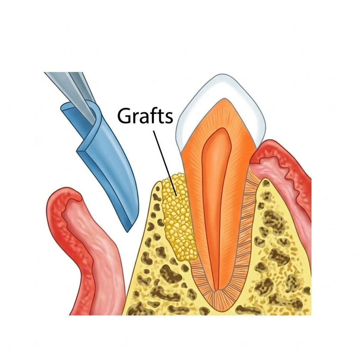 Cologenesis ColoGide GTR Membrane – Pack Of 1 Free Shipping