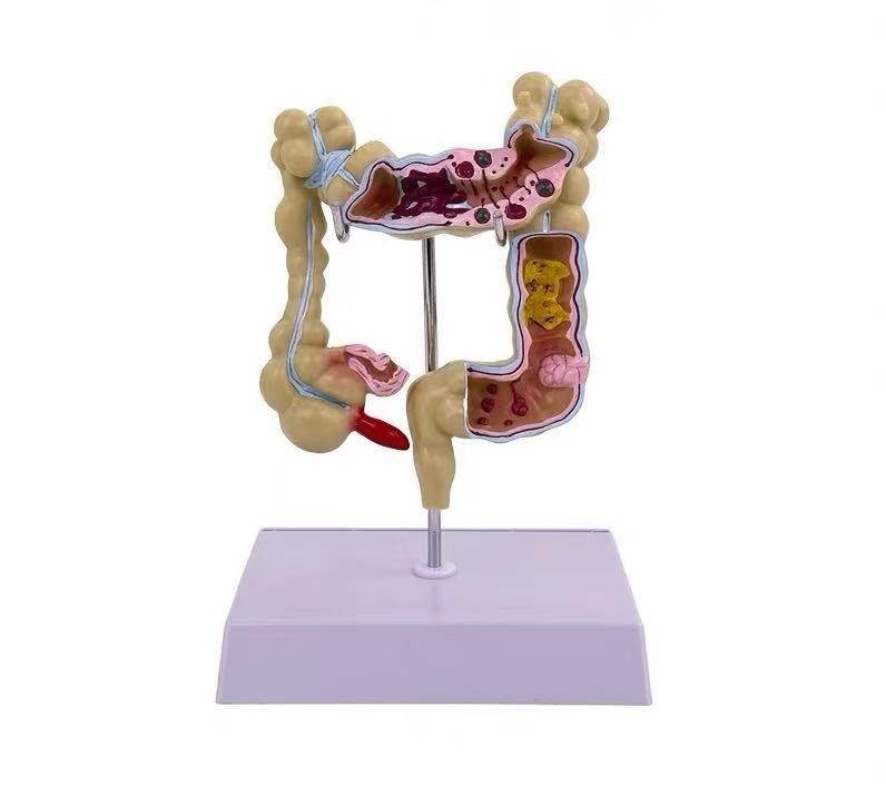 Anatomical Human Colon Intestine Pathological Diseases Model Medical Anatomy