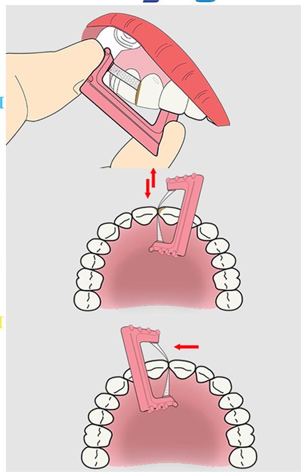 Dental Orthodontic Interproximal IPR IR Reduction Polishing Saw Enamel Strip Tip