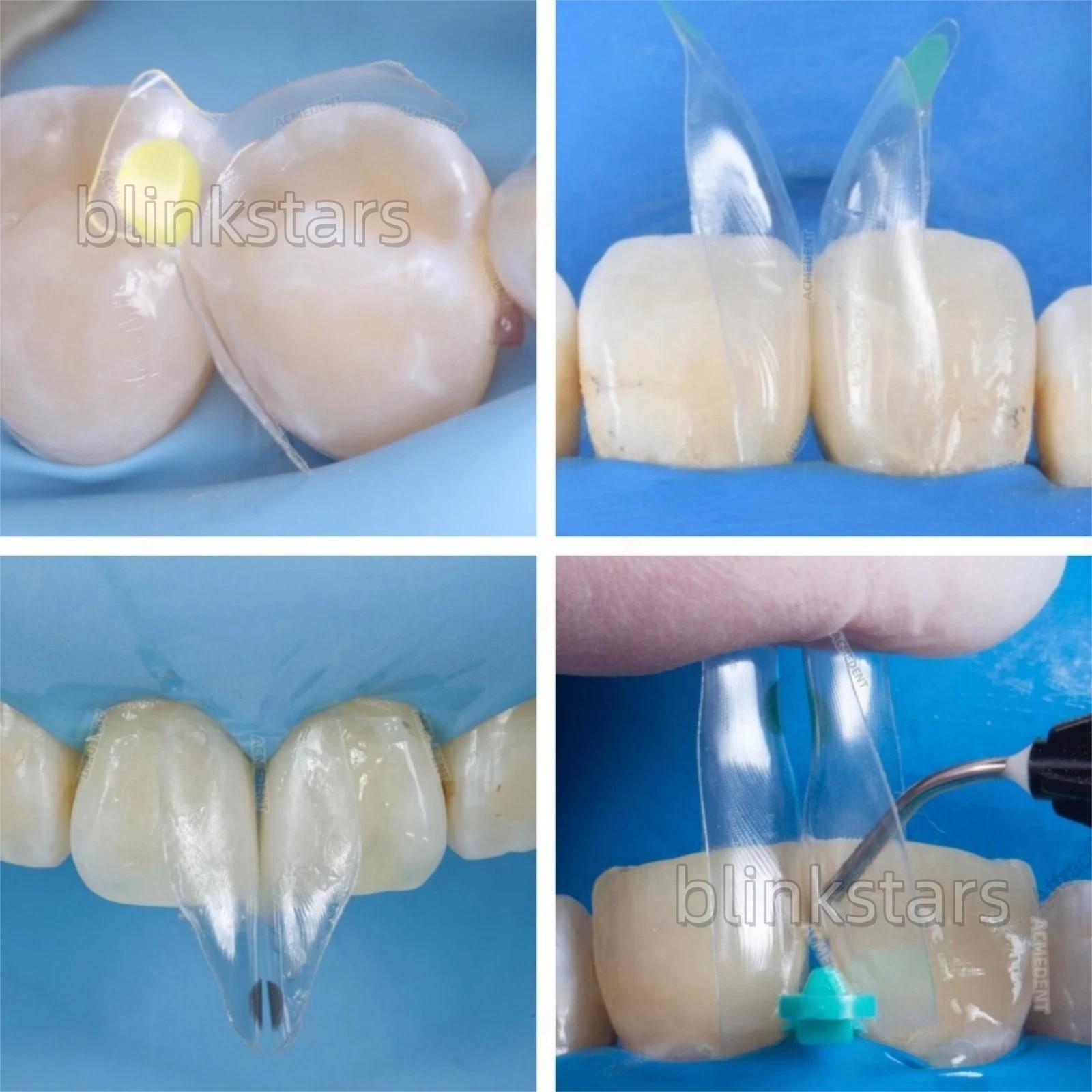 5 Pcs/Box Dental Restorative BT Bow Matrices Matrix Contoured Bands Transparent