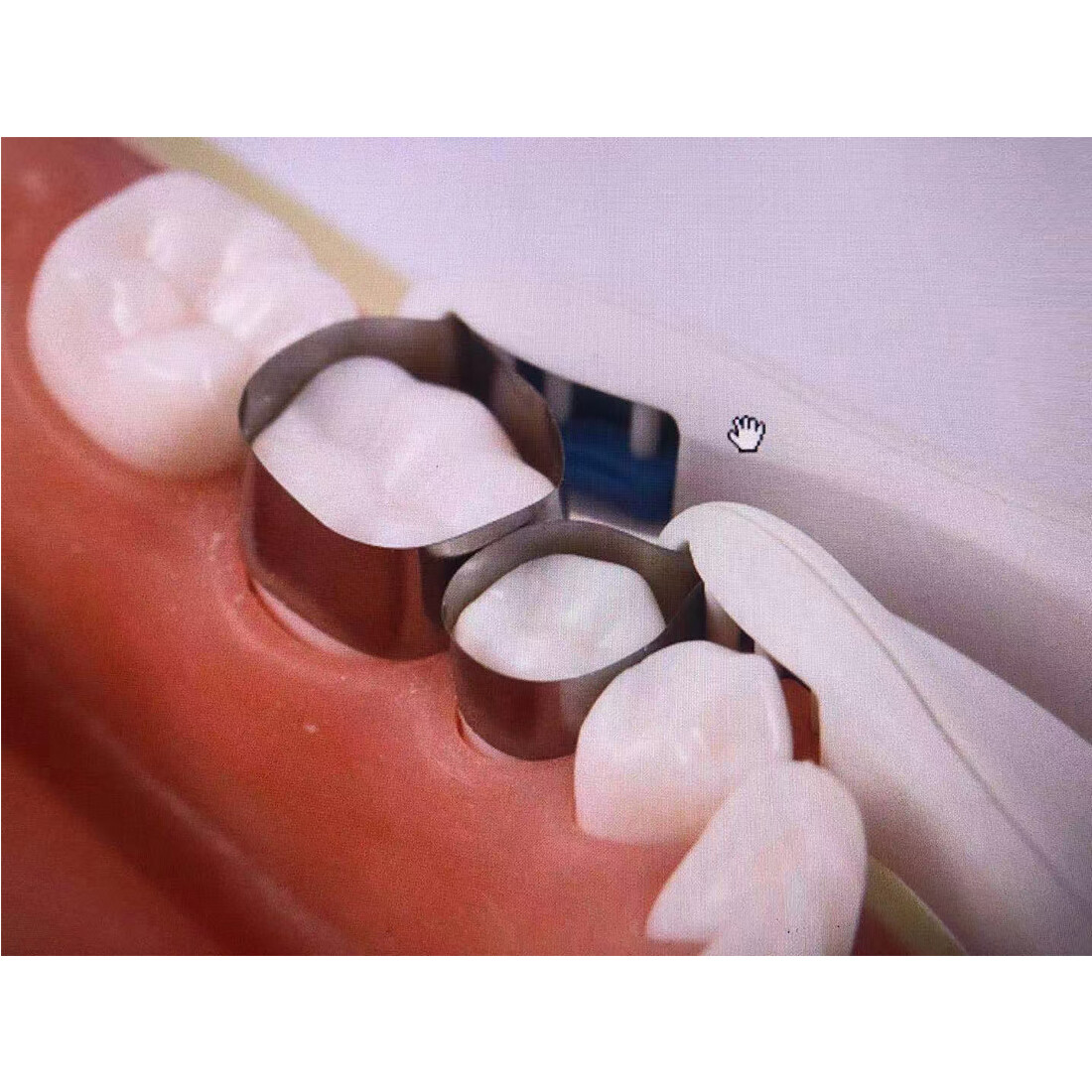 10pcs/box EASYINSMILE Dental Pro Matrix Bands Pre Formed 6MM Standard Adjustable