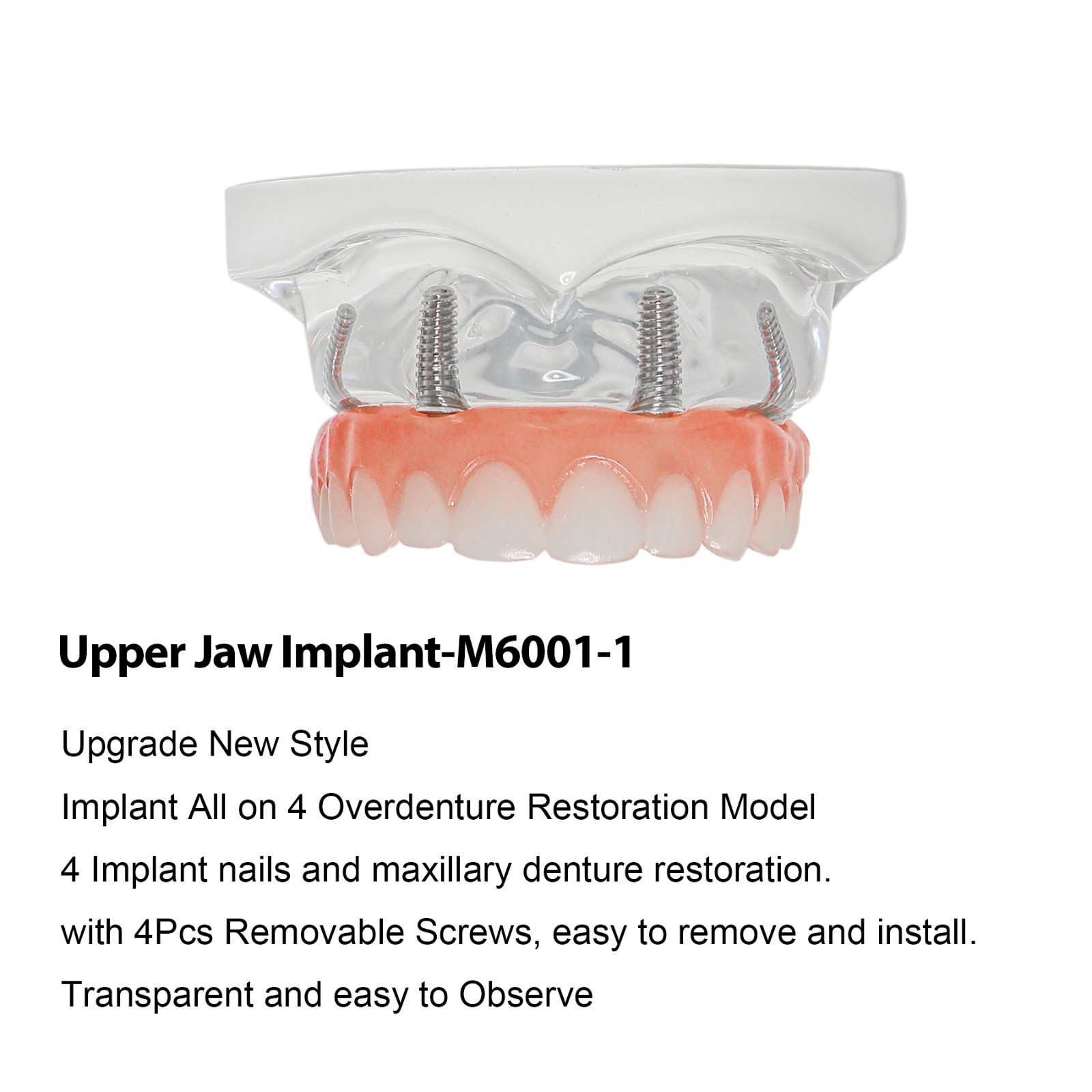 Dental Implant Overdenture Model Upper Lower Jaw Teeth Model with 2/4/6 Screws