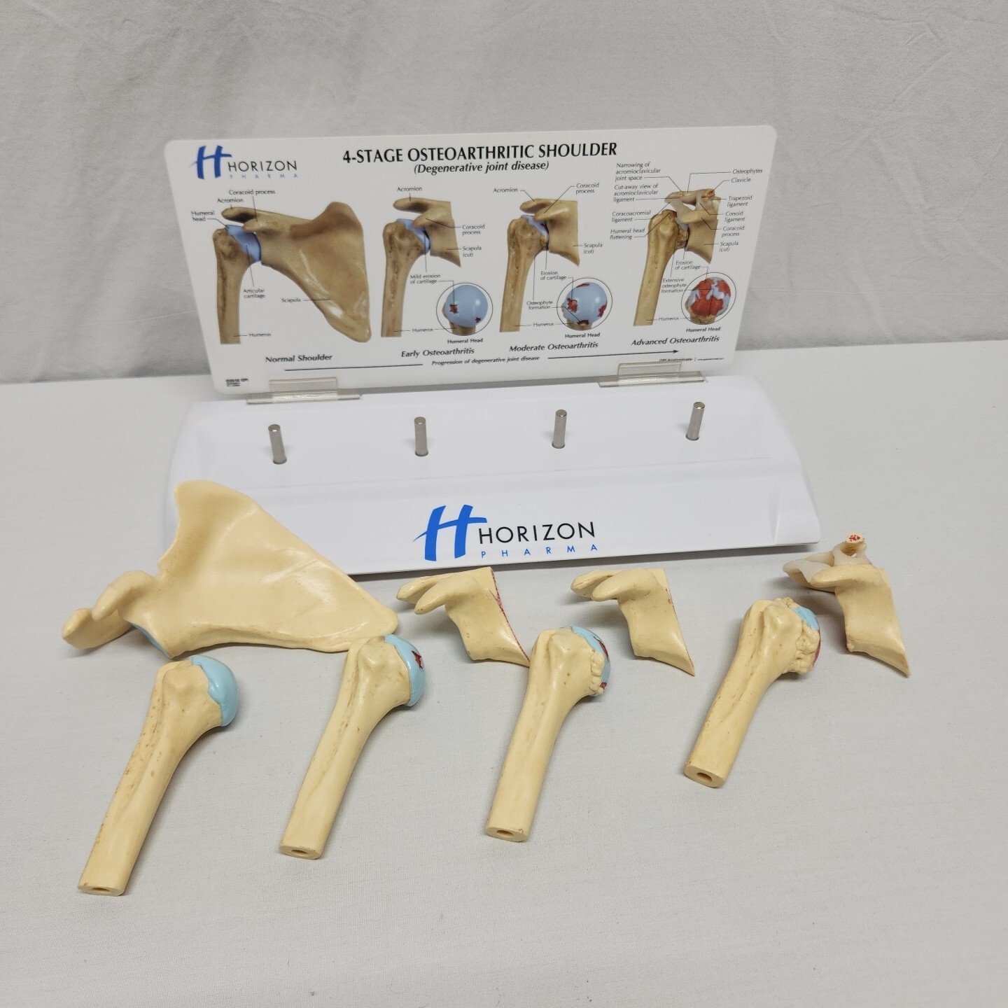 Degenerative Joint Disease 4 Stage Osteoarthritis Osteoarthritic Shoulder Model