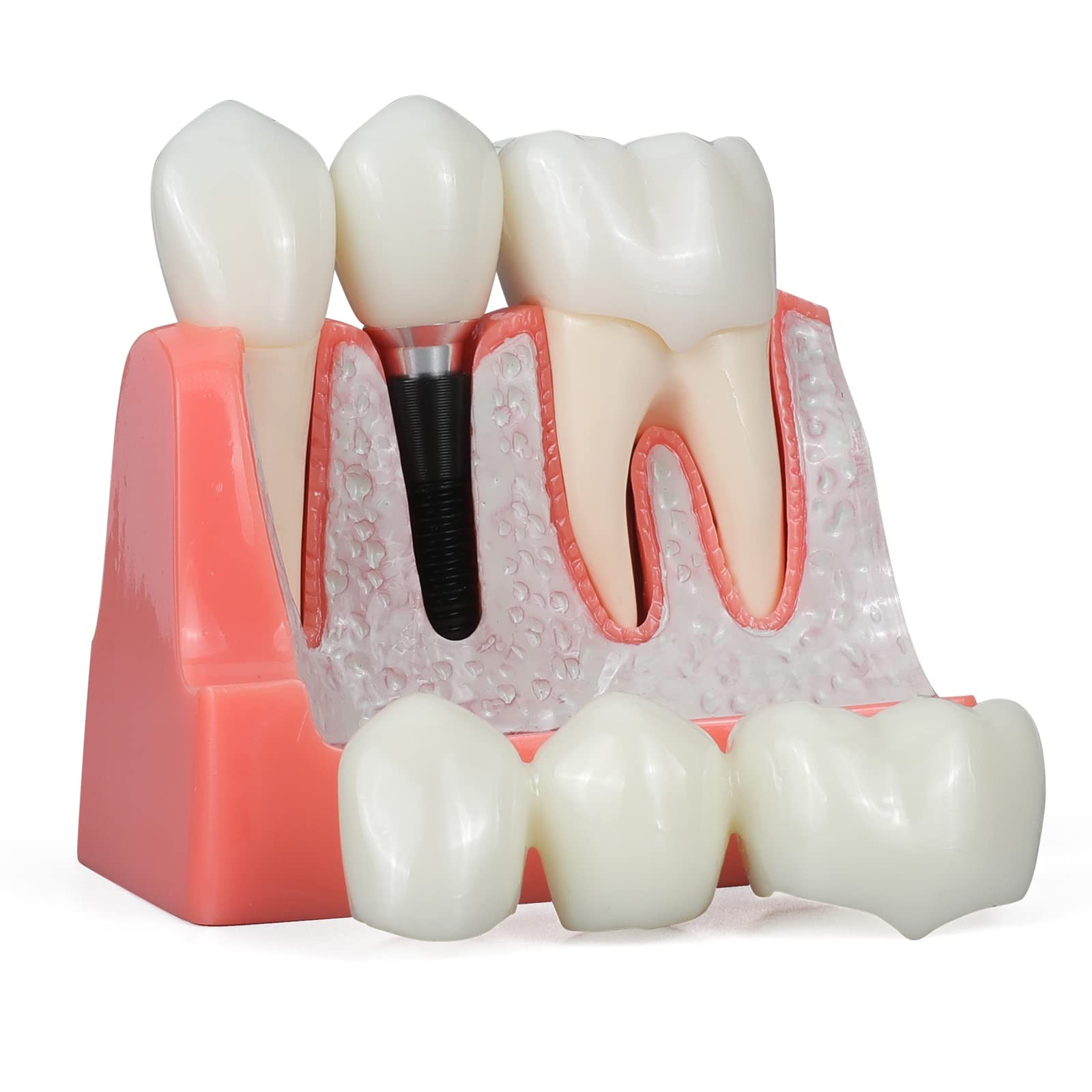 ANNWAN Dental Implant Model 4 Times Removable Analysis 4