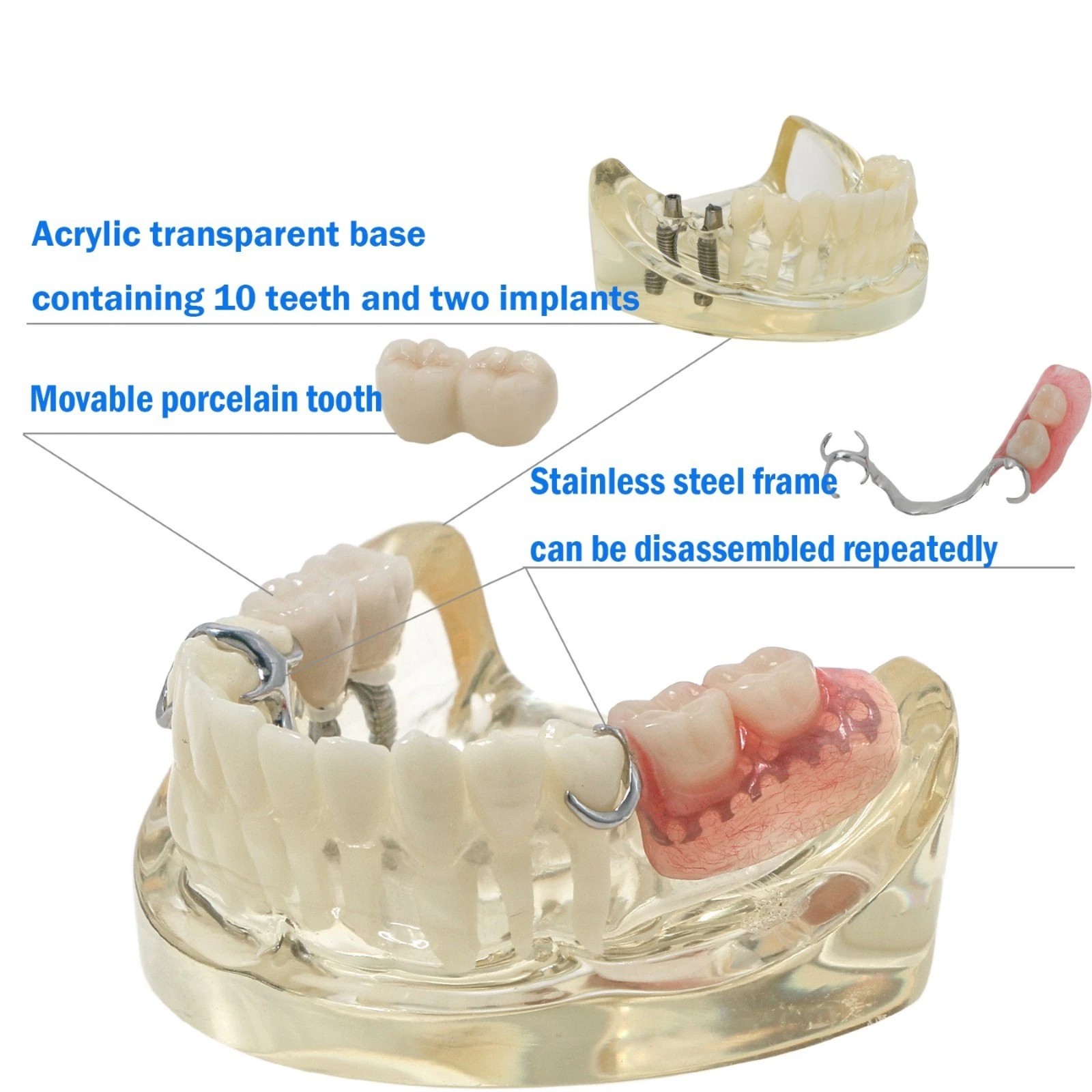 Typodont Restoration Dental Teeth Model With Partial Denture Demo 2 Implants