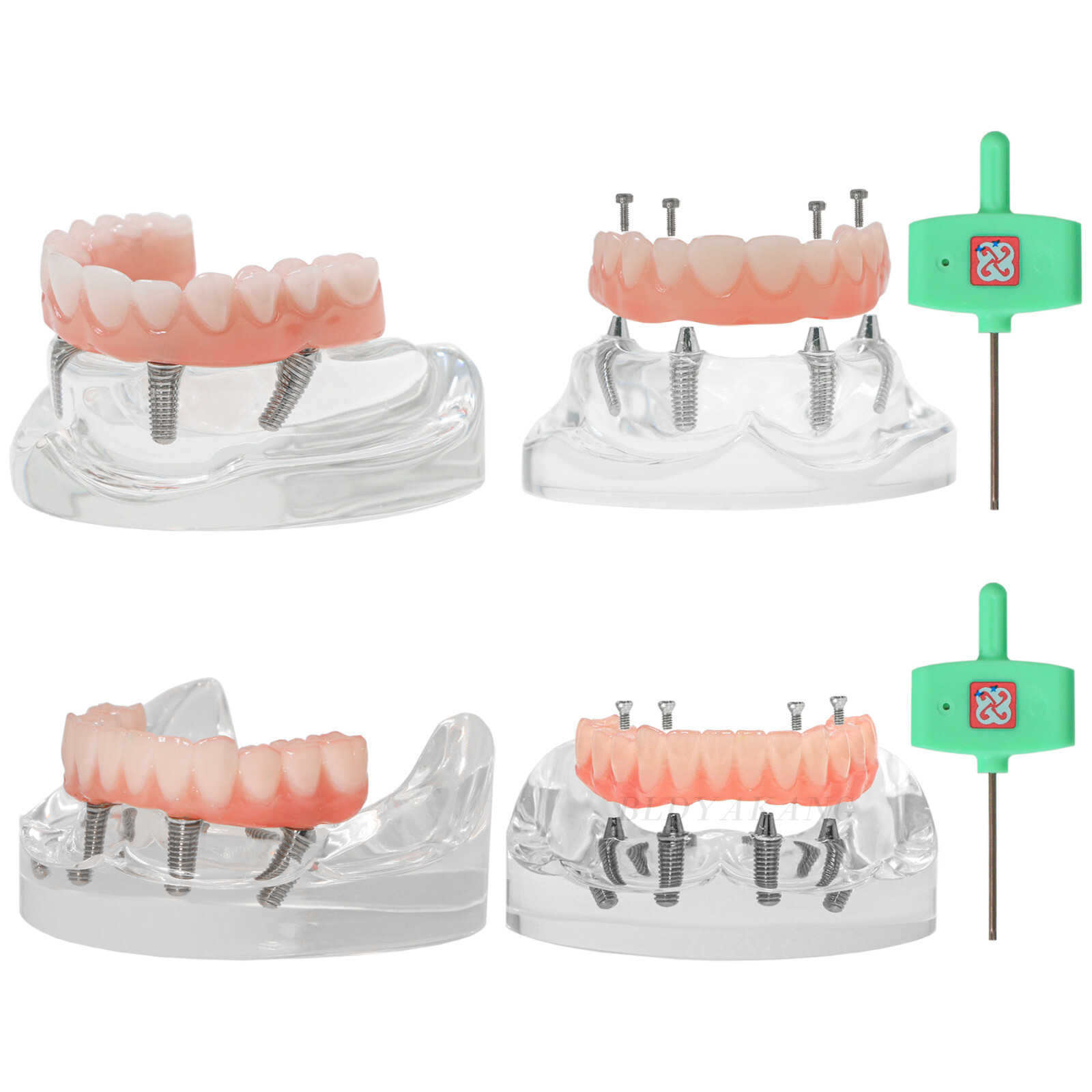 Dental 4 Implants Upper&Lower Demo Implant Teeth Model Restoration Overdenture