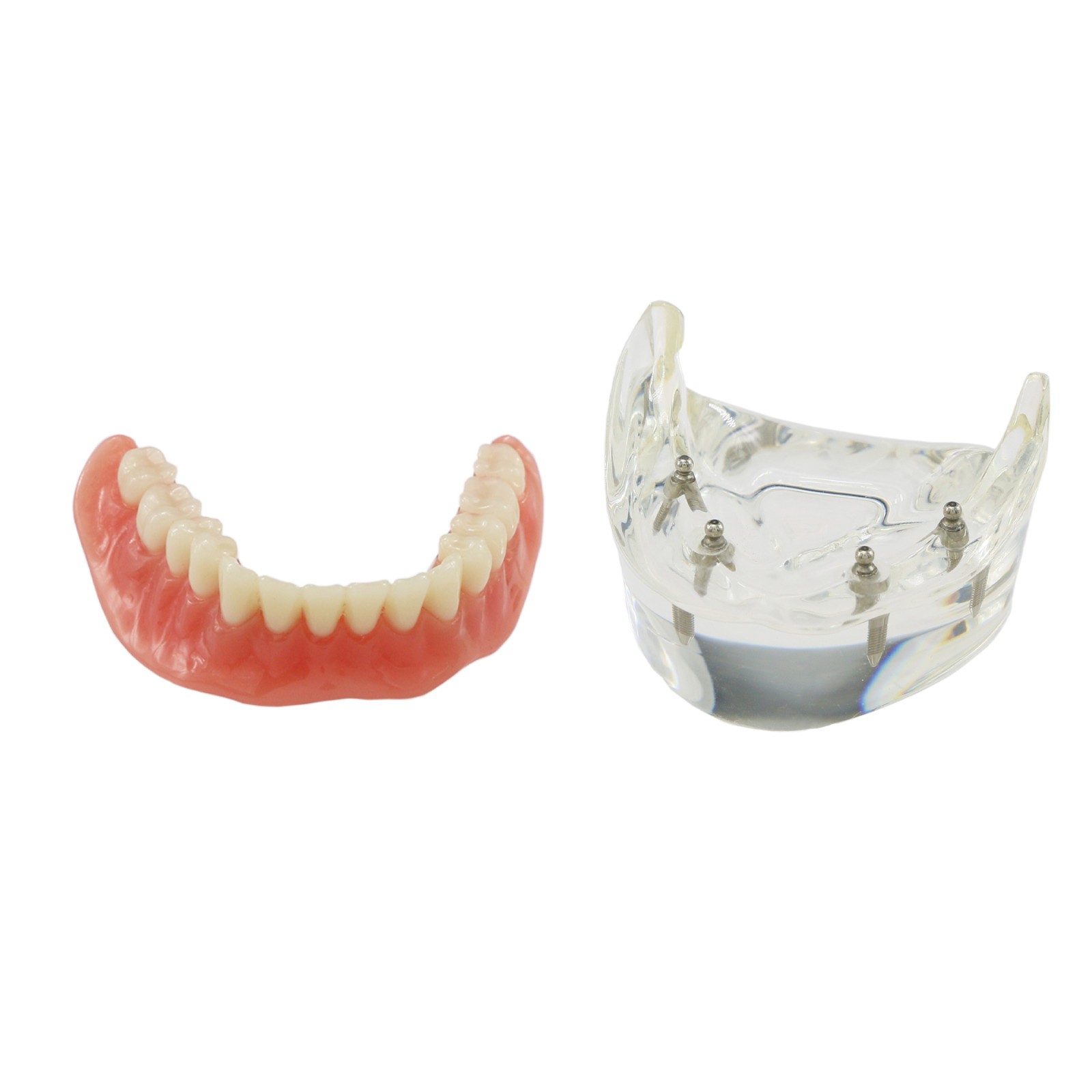 Dental Teeth Model 2 4 Implant Overdenture Typodont Restoration Demo Upper Lower