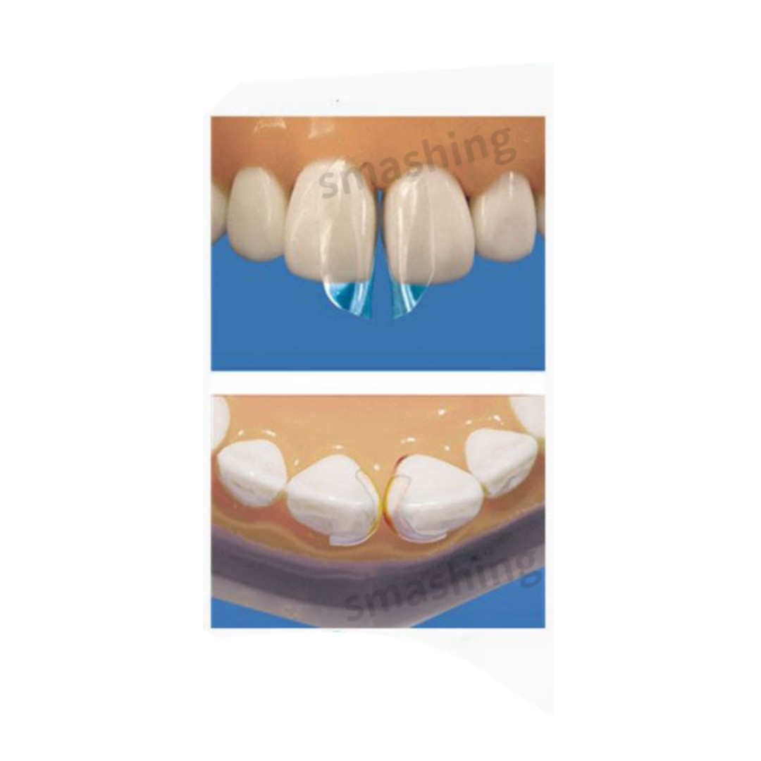 Dental Clear Matrix Anterior Matrices Bow BT Fits Bioclear L/M/S Mixed Sizes 1.9