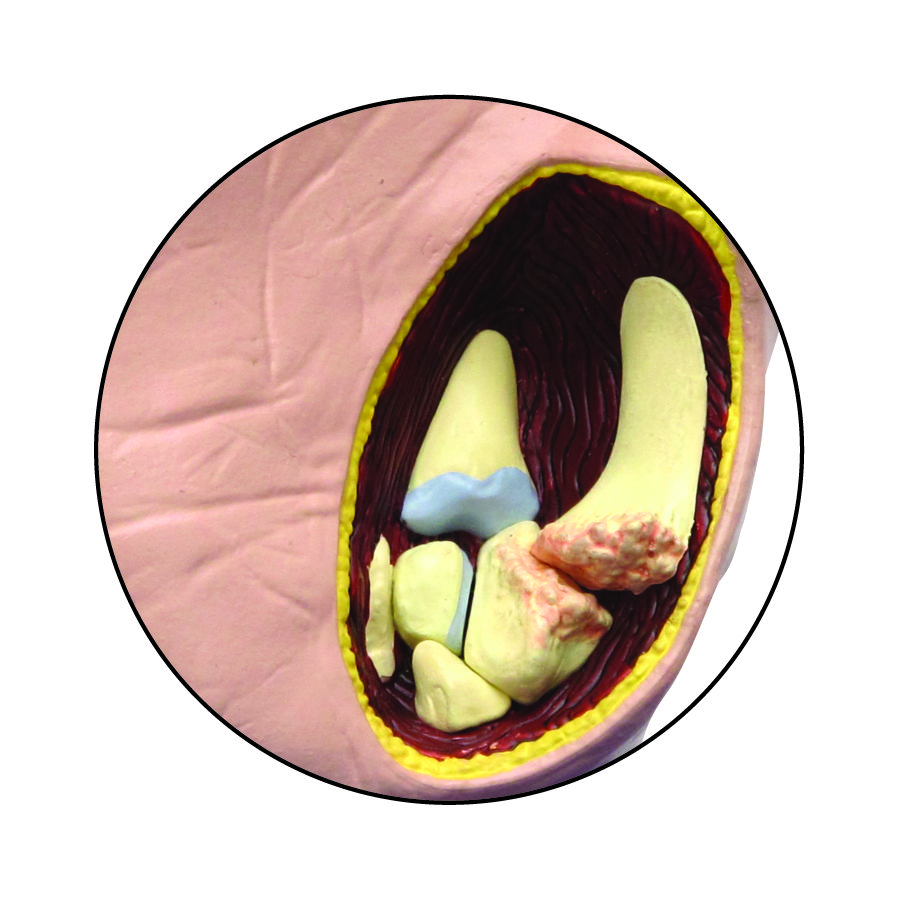 Hand Osteoarthritis (OA) GPI Anatomical Model LFA # 1930.Make Us An Offer! VIDEO