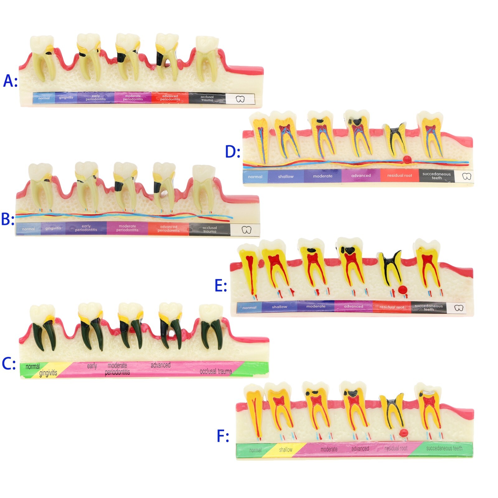 Dental Typodont Teeth Model Ortho Implant Pathological Perio Practice Demo Model