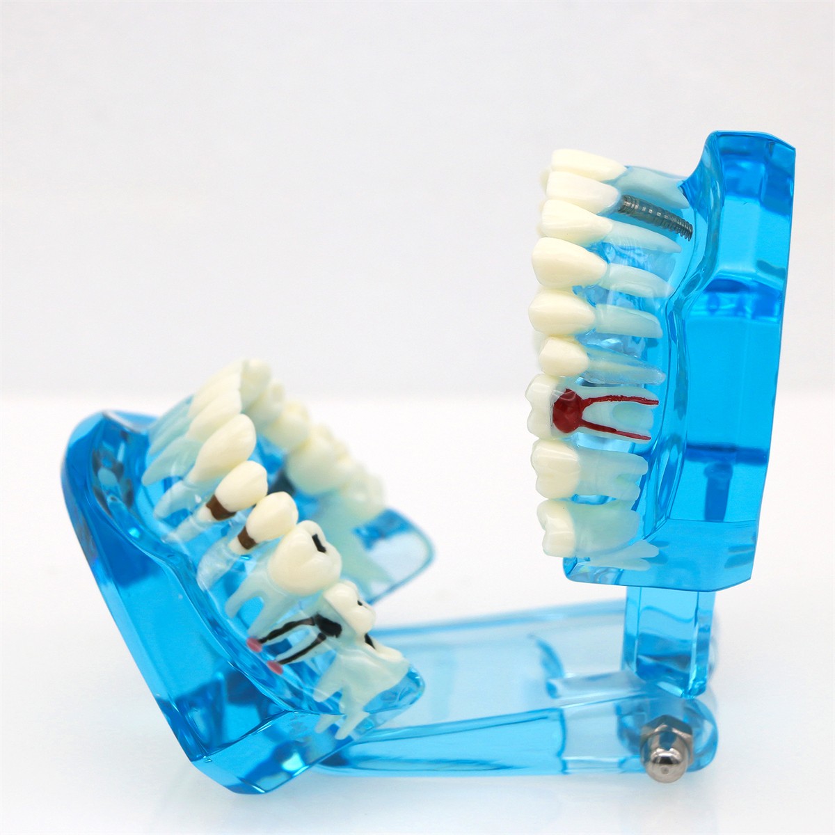 US Dental Typodont Teeth Model Implant Restoration Orthodontics Demo Teaching