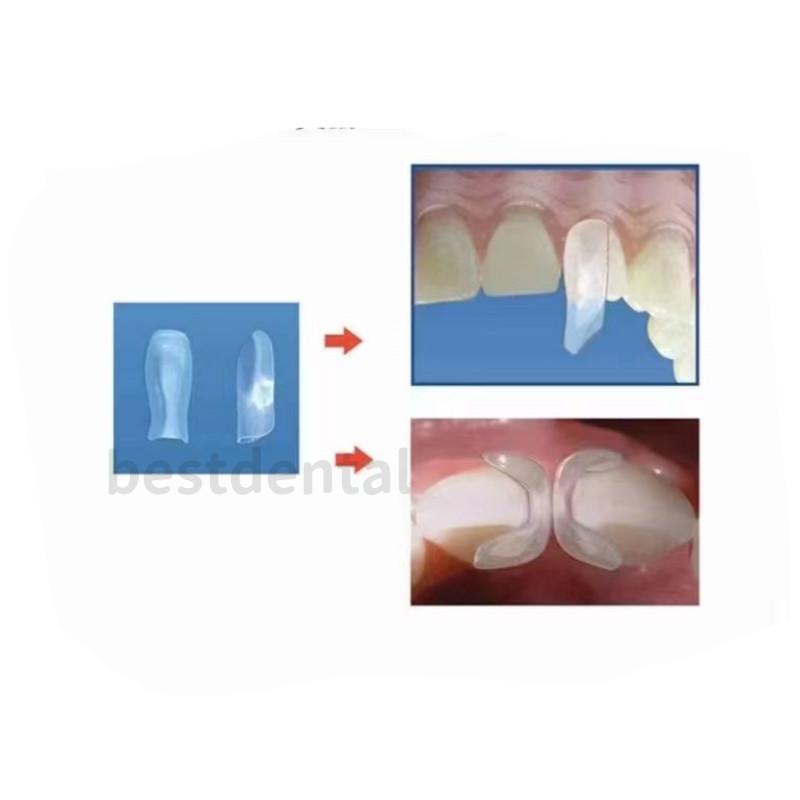Dental Clear Matrix Transparent Anterior Matrices Bow Fit Bioclear L/M/S TOR VM