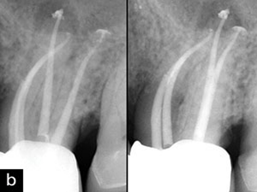 WaveOne Gold Primary 21mm Endodontic Root Canal 3 Files. READ