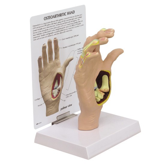 Hand Osteoarthritis (OA) GPI Anatomical Model LFA # 1930.Make Us An Offer! VIDEO