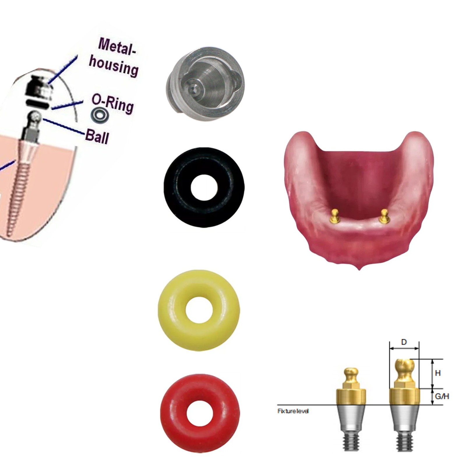 4Pc/Set Implant O-Ring Retention Cap Kit for Hiossen Osstem Ball Abutment Dental